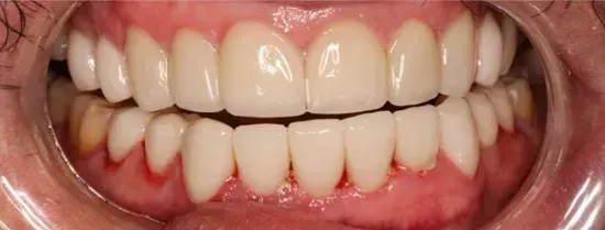 Close-up of upper and lower teeth with visible gums and mouth interior