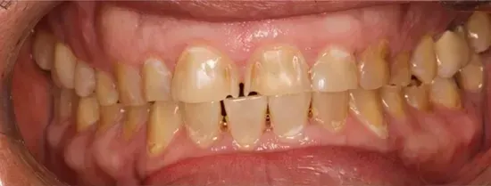 Close-up of teeth with yellow discoloration, plaque buildup, and visible dark staining