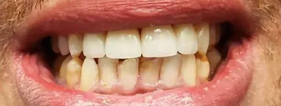 Close-up of a person's mouth showing teeth with discoloration and staining near gums