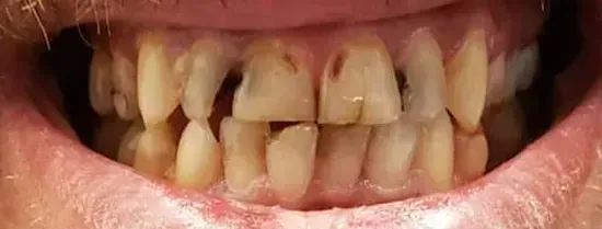 Close-up of a person's mouth showing severely discolored, worn, and misaligned teeth