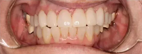 Close-up of a person's mouth showing upper and lower teeth with dental retractors