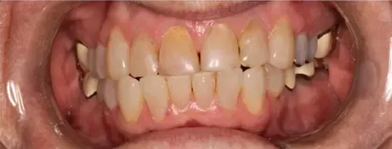 Close-up of a person's teeth showing discoloration, staining, and gum tissue