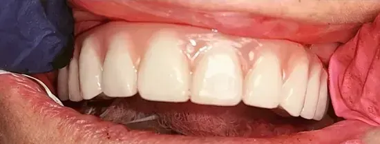 Close-up of upper teeth with dental restoration, retracted by gloved fingers
