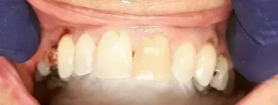 Close-up of upper front teeth with discoloration, gloved fingers retracting lips