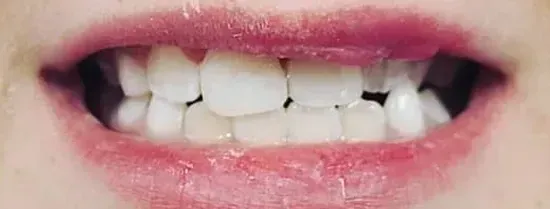 Close-up of a smiling mouth showing upper front teeth and pink lips