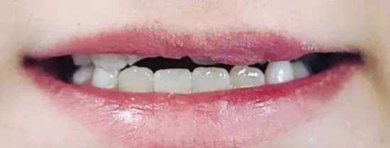 Close-up of a person's smiling mouth showing upper and lower teeth