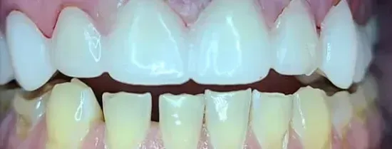 Close-up of upper and lower teeth showing color contrast between whitened top row and natural bottom row
