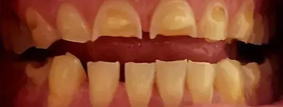 Close-up of teeth with yellow discoloration and visible tartar buildup, mouth open