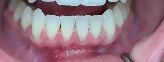 Close-up of lower teeth and gums with a dental mirror reflecting below