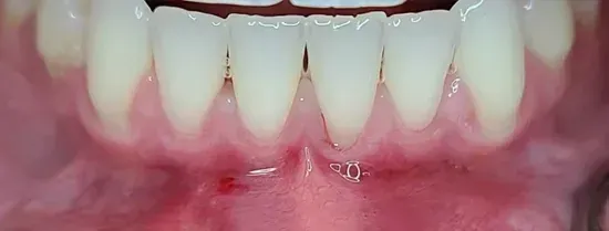 Close-up of lower front teeth with visible gum recession and slight bleeding