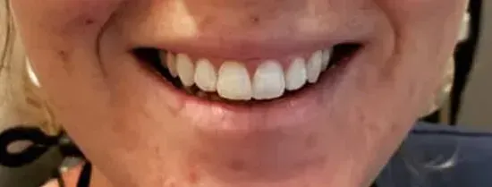 Close-up of a smiling mouth showing white upper and lower teeth