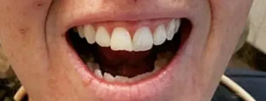 Close-up of a person's open mouth showing upper teeth and smiling lips