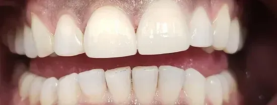 Close-up of upper and lower teeth showing healthy white smile and gums
