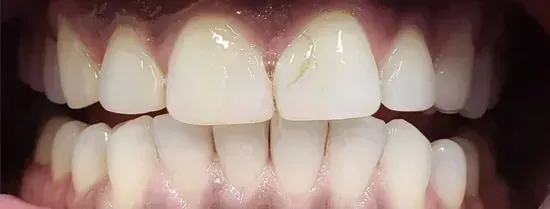Close-up view of upper and lower front teeth and gums, mouth open