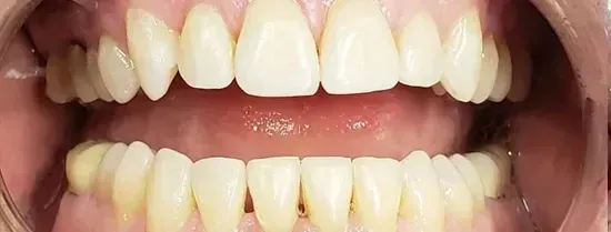 Close-up of upper and lower teeth showing slight yellowing and gum tissue
