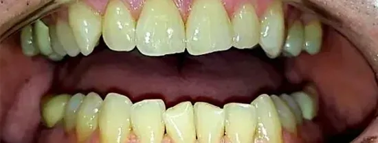 Close-up of a person's teeth showing yellow discoloration and gums