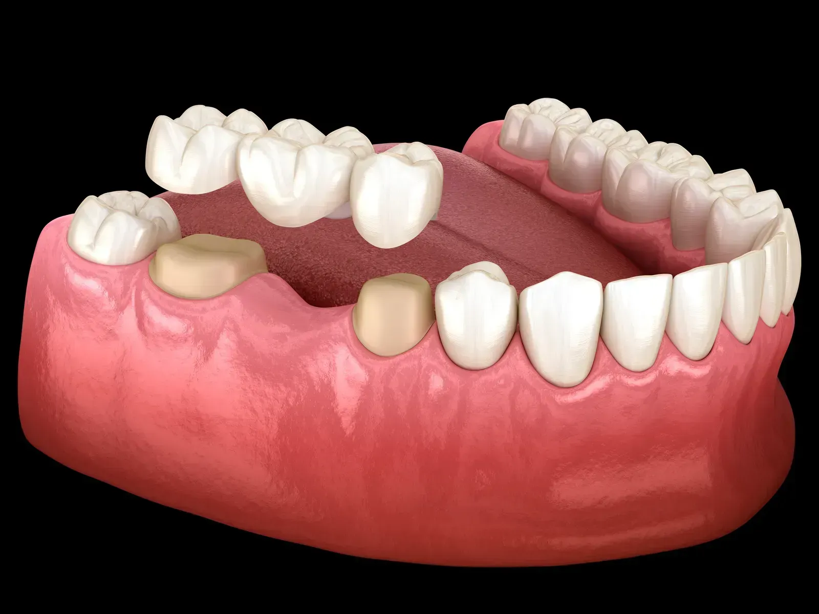 Dental Crowns at Clear Sky Dental Care