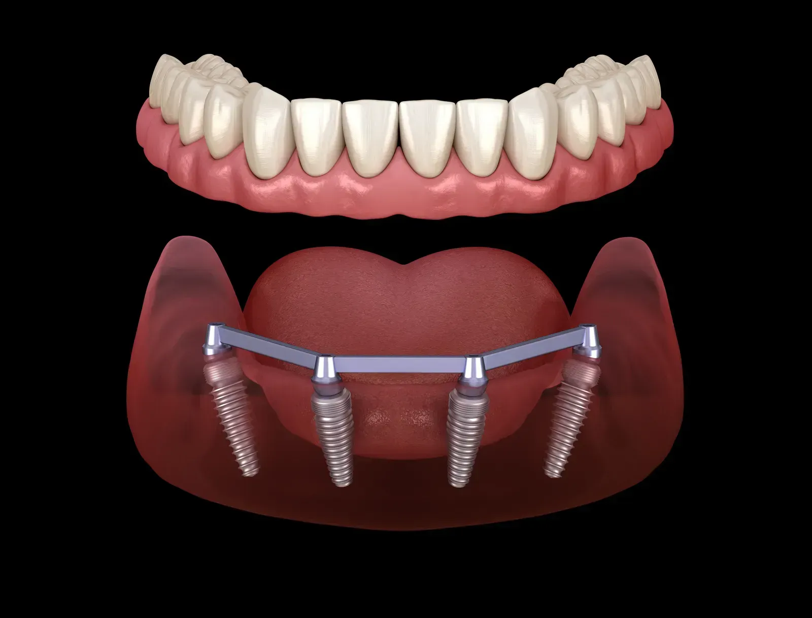 Dental Implants at Clear Sky Dental Care